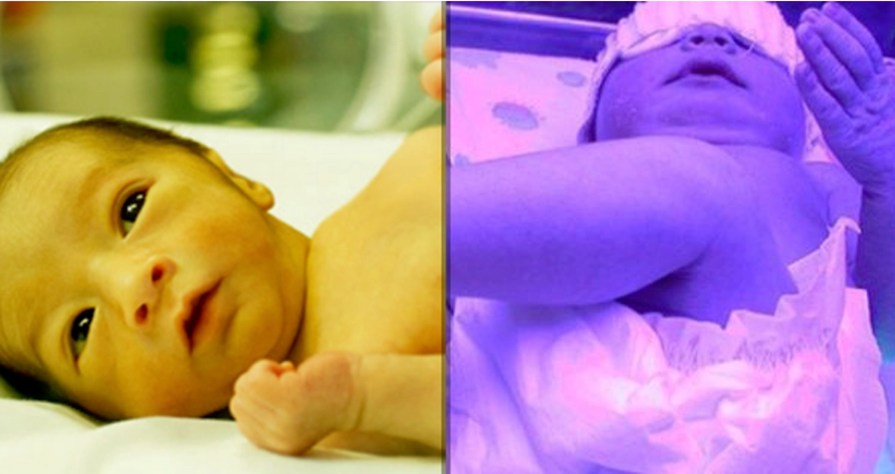 Reasons Babies Can Jaundice BabyGaga